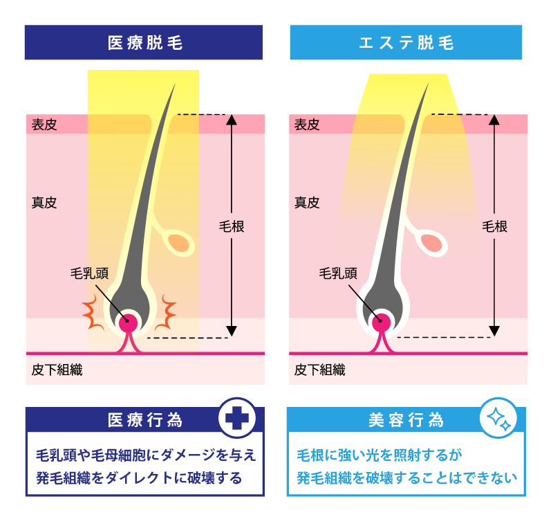 医療脱毛とエステ脱毛の違い