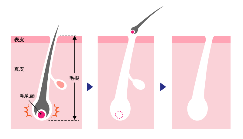 医療脱毛の仕組み